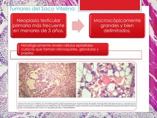 Neoplasia testicular
primaria más frecuente
en menores de 3 años.
Macroscópicamente
grandes y bien
delimitados.
Tumores del Saco Vitelino:
Histológicamente revela células epiteliales
cubicas que forman Microquistes, glándulas y
papilas.
 