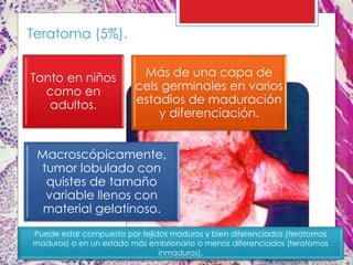 Teratoma (5%).
Tanto en niños
como en
adultos.
Más de una capa de
cels germinales en varios
estadios de maduración
y diferenciación.
Macroscópicamente,
tumor lobulado con
quistes de tamaño
variable llenos con
material gelatinoso.
Puede estar compuesto por tejidos maduros y bien diferenciados (teratomas
maduros) o en un estado más embrionario o menos diferenciados (teratomas
inmaduros).
 
