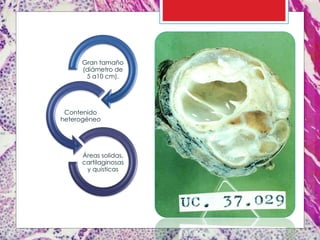 Gran tamaño
(diámetro de
5 a10 cm).
Contenido
heterogéneo
Áreas solidas,
cartilaginosas
y quísticas
 