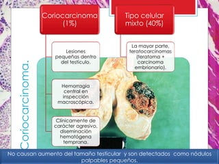 Coriocarcinoma
(1%)
Lesiones
pequeñas dentro
del testículo.
Hemorragia
central en
inspección
macroscópica.
Clínicamente de
carácter agresivo,
diseminación
hematógena
temprana.
Tipo celular
mixto (40%)
La mayor parte,
teratocarcinomas
(teratoma +
carcinoma
embrionario).
Coriocarcinoma.
No causan aumento del tamaño testicular y son detectados como nódulos
palpables pequeños.
 