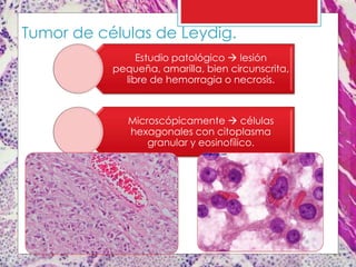 Tumor de células de Leydig.
Estudio patológico  lesión
pequeña, amarilla, bien circunscrita,
libre de hemorragia o necrosis.
Microscópicamente  células
hexagonales con citoplasma
granular y eosinofílico.
 
