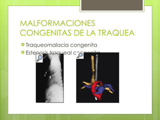 MALFORMACIONES CONGENITAS DE LA TRAQUEA <ul><li>Traqueomalacia congenita </li></ul><ul><li>Estenosis traqueal congenita </...