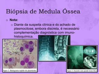 Biópsia de Medula Óssea
o Nota:
   o Diante da suspeita clínica e do achado de
     plasmocitose, embora discreta, é necessário
     complementação diagnóstica com imuno-
     histoquímica.
 