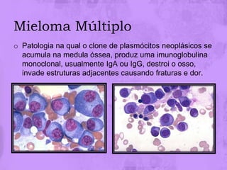 Mieloma Múltiplo
o Patologia na qual o clone de plasmócitos neoplásicos se
  acumula na medula óssea, produz uma imunoglobulina
  monoclonal, usualmente IgA ou IgG, destroi o osso,
  invade estruturas adjacentes causando fraturas e dor.
 