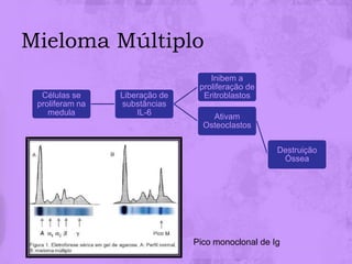 Mieloma Múltiplo
                                    Inibem a
                                 proliferação de
  Células se     Liberação de     Eritroblastos
 proliferam na   substâncias
    medula           IL-6           Ativam
                                  Osteoclastos

                                                    Destruição
                                                     Óssea




                                Pico monoclonal de Ig
 
