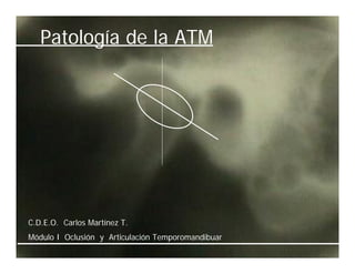 Patología de la ATM




C.D.E.O. Carlos Martínez T.
Módulo I Oclusión y Articulación Temporomandibuar