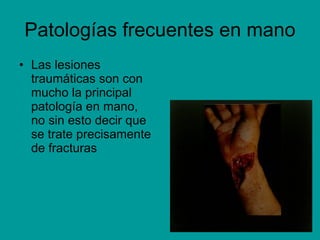 Patologías frecuentes en mano Las lesiones traumáticas son con mucho la principal patología en mano, no sin esto decir que se trate precisamente de fracturas 