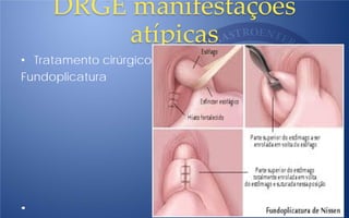 DRGE manifestaçòes
atípicas
• Tratamento cirúrgico:
Fundoplicatura
 