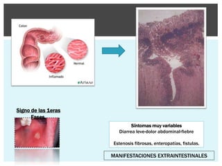 Signo de las 1eras
      Fases.
                             Síntomas muy variables
                       Diarrea leve-dolor abdominal-fiebre

                     Estenosis fibrosas, enteropatías, fistulas.

                     MANIFESTACIONES EXTRAINTESTINALES
 