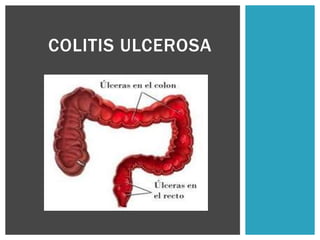 COLITIS ULCEROSA
 