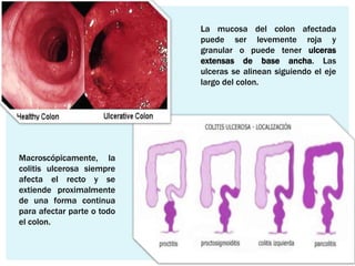 La mucosa del colon afectada
                            puede ser levemente roja y
                            granular o puede tener ulceras
                            extensas de base ancha. Las
                            ulceras se alinean siguiendo el eje
                            largo del colon.




Macroscópicamente, la
colitis ulcerosa siempre
afecta el recto y se
extiende proximalmente
de una forma continua
para afectar parte o todo
el colon.
 