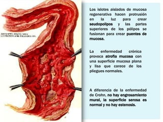 Los islotes aislados de mucosa
regenerativa hacen protrusión
en     la   luz    para   crear
seudopolipos y las partes
superiores de los pólipos se
fusionan para crear puentes de
mucosa.


La    enfermedad    crónica
provoca atrofia mucosa con
una superficie mucosa plana
y lisa que carece de los
pliegues normales.



A diferencia de la enfermedad
de Crohn, no hay engrosamiento
mural, la superficie serosa es
normal y no hay estenosis.
 