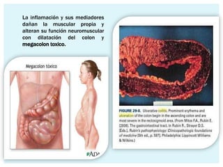 La inflamación y sus mediadores
dañan la muscular propia y
alteran su función neuromuscular
con dilatación del colon y
megacolon toxico.
 