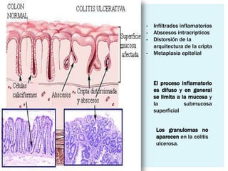 -   Infiltrados inflamatorios
-   Abscesos intracripticos
-   Distorsión de la
    arquitectura de la cripta
-   Metaplasia epitelial




    El proceso inflamatorio
    es difuso y en general
    se limita a la mucosa y
    la           submucosa
    superficial


     Los granulomas no
     aparecen en la colitis
     ulcerosa.
 
