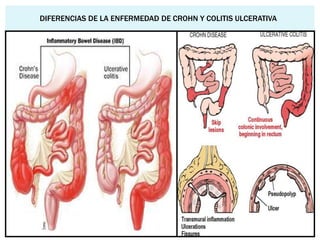 DIFERENCIAS DE LA ENFERMEDAD DE CROHN Y COLITIS ULCERATIVA
 