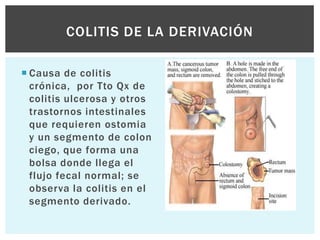 COLITIS DE LA DERIVACIÓN

 Causa de colitis
  crónica, por Tto Qx de
  colitis ulcerosa y otros
  trastornos intestinales
  que requieren ostomia
  y un segmento de colon
  ciego, que forma una
  bolsa donde llega el
  flujo fecal normal; se
  observa la colitis en el
  segmento derivado.
 