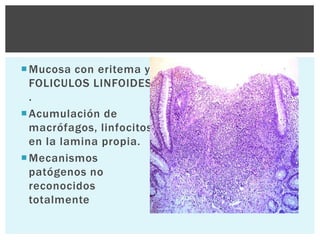  Mucosa con eritema y
  FOLICULOS LINFOIDES
  .
 Acumulación de
  macrófagos, linfocitos
  en la lamina propia.
 Mecanismos
  patógenos no
  reconocidos
  totalmente
 