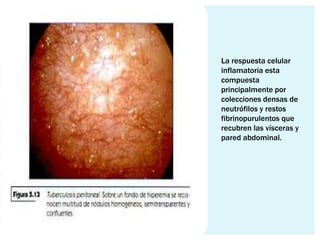 La respuesta celular
inflamatoria esta
compuesta
principalmente por
colecciones densas de
neutrófilos y restos
fibrinopurulentos que
recubren las vísceras y
pared abdominal.
 