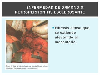 ENFERMEDAD DE ORMOND O
RETROPERITONITIS ESCLEROSANTE


               Fibrosis densa que
                se extiende
                afectando al
                mesenterio.
 