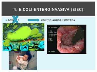 4. E.COLI ENTEROINVASIVA (EIEC)

 TOXINAS        COLITIS AGUDA LIMITADA
 
