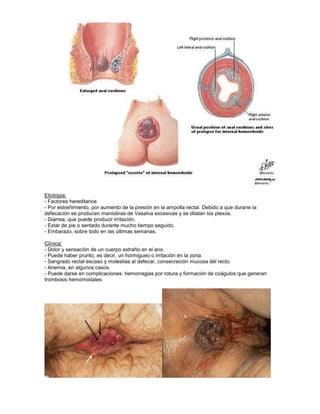 Etiología:
- Factores hereditarios
- Por estreñimiento, por aumento de la presión en la ampolla rectal. Debido a que durane la
defecación se producen maniobras de Vasalva excesivas y se dilatan los plexos.
- Diarrea, que puede producir irritación.
- Estar de pie o sentado durante mucho tiempo seguido.
- Embarazo, sobre todo en las últimas semanas.
Clínica:
- Dolor y sensación de un cuerpo extraño en el ano.
- Puede haber prurito, es decir, un hormigueo o irritación en la zona.
- Sangrado rectal escaso y molestias al defecar, consecreción mucosa del recto.
- Anemia, en algunos casos.
- Puede darse en complicaciones: hemorragias por rotura y formación de coágulos que generan
trombosis hemorroidales.
 