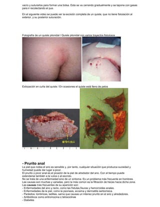 vacío y suturarlos para formar una bolsa. Esta se va cerrando gradualmente y se tapona con gasas
para ir recolectando el pus.
En el siguiente video se puede ver la excisión completa de un quiste, que no tiene fistulación al
exterior, y su posterior suturación.
Fotografía de un quiste pilonidal / Quiste pilonidal con varios trayectos fistulosos
Extirpación en cuña del quiste / En ocasiones el quiste está lleno de pelos
- Prurito anal
La piel que rodea el ano es sensible y, por tanto, cualquier situación que produzca suciedad y
humedad puede dar lugar a picor.
El prurito o picor anal es el picazón de la piel de alrededor del ano. Con el tiempo puede
extenderse también a la vulva o al escroto.
No se trata de una enfermedad sino de un síntoma. Es un problema más frecuente en hombres.
Las causas son muchas y variadas, pero la más común es la filtración de heces hacia dicha zona.
Las causas más frecuentes de su aparición son:
- Enfermedades del ano y recto, como las fístulas,fisuras y hemorroides anales.
- Enfermedades de la piel, como la psoriasis, eccema y dermatitis serborreica.
- Parásitos: lombrices, ladillas, sarna que causas un intenso prurito en el ano y alrededores.
- Antibióticos como eritromocina o tetraciclinas
- Diabetes
 