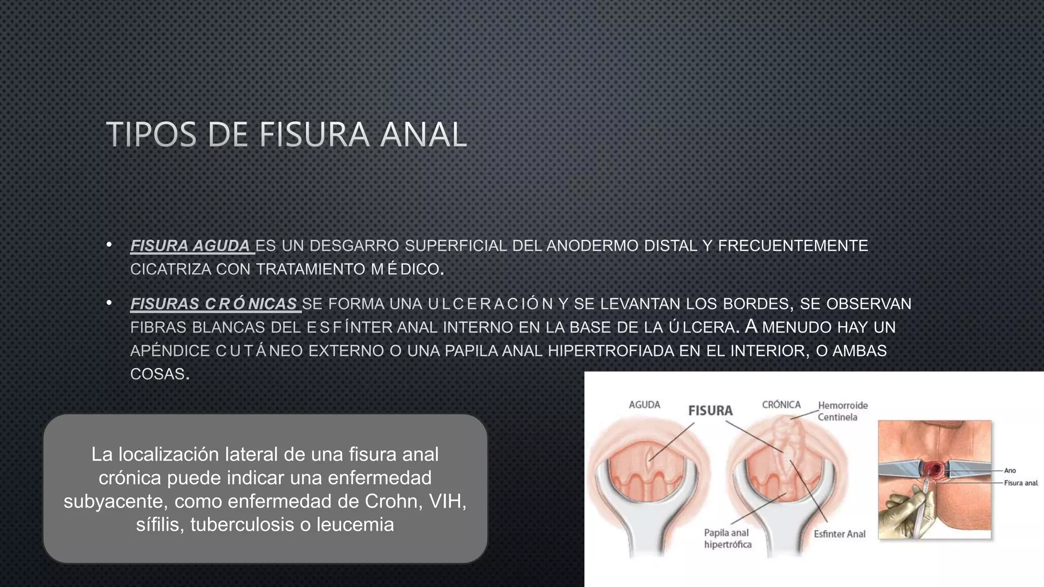 Patologia Anorectal Hemorroides Abscesos Fistulas Y Fisura pptx patologia-anorectal-hemorroides-abscesos-fistulas-y-fisura-pptx