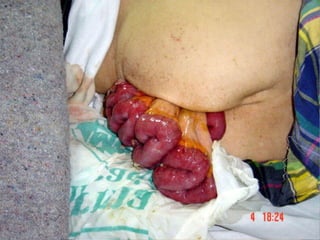 Patologia anorectales