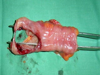 Patologia anorectales