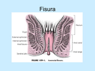 Patologia anorectales