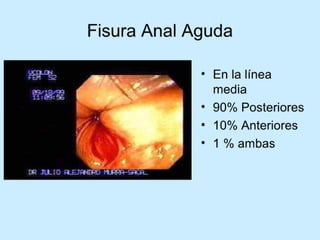 Patologia anorectales
