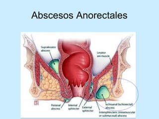 Patologia anorectales