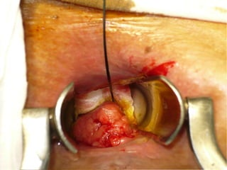 Patologia anorectales