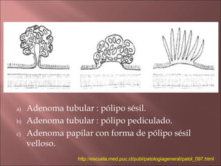 a)   Adenoma tubular : pólipo sésil.
b)   Adenoma tubular : pólipo pediculado.
c)   Adenoma papilar con forma de pólipo sésil
     velloso.
                 http://escuela.med.puc.cl/publ/patologiageneral/patol_097.html
 