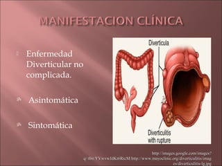    Enfermedad
    Diverticular no
    complicada.

   Asintomática

   Sintomática


                                                      http://images.google.com/images?
                      q=tbn:YVwvwJdKt6RtcM:http://www.mayoclinic.org/diverticulitis/imag
                                                                  es/diverticulitis-lg.jpg
 