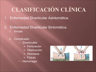 CLASIFICACIÓN CLÍNICA
1. Enfermedad Diverticular Asintomática.

2. Enfermedad Diverticular Sintomática.
  1. Simple

  2. Complicada:
        – Diverticulitis
            » Perforación
            » Obstrucción
            » Abscesos
            » Fístula
        – Hemorragia
 