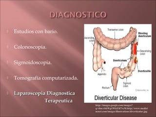    Estudios con bario.

   Colonoscopia.

   Sigmoidoscopia.

   Tomografía computarizada.

   Laparoscopia Diagnostica
                Terapeutica
                                http://images.google.com/images?
                                q=tbn:vbkWp1WkEH7txM:http://www.medici
                                nenet.com/images/illustrations/diverticular.jpg
 