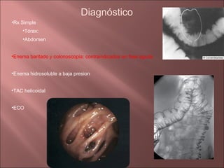 Diagnóstico
•Rx Simple
    •Tórax:
    •Abdomen


•Enema baritado y colonoscopia: contraindicados en fase aguda


•Enema hidrosoluble a baja presion


•TAC helicoidal


•ECO
 