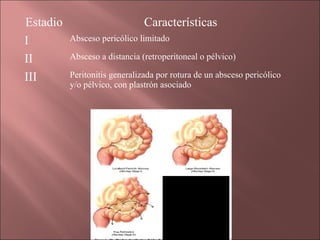 Estadio                        Características
I         Absceso pericólico limitado

II        Absceso a distancia (retroperitoneal o pélvico)

III       Peritonitis generalizada por rotura de un absceso pericólico
          y/o pélvico, con plastrón asociado
 