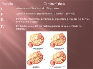 Estadio                              Características
I          Absceso pericólico limitado. Flegmonosa

II         Absceso a distancia (retroperitoneal o pélvico). Tabicado

III        Peritonitis generalizada por rotura de un absceso pericólico y/o pélvico,
           con plastrón asociado

IV         Peritonitis fecaloidea por perforación libre de un divertículo no
           inflamado
 