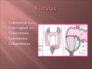    Colovesical (50-65%).
   Colovaginal (25%)
   Colocutánea
   Colouterina
   Coloentéricas
 