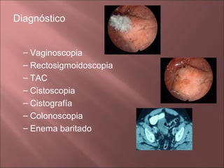 Diagnóstico


  – Vaginoscopia
  – Rectosigmoidoscopia
  – TAC
  – Cistoscopia
  – Cistografía
  – Colonoscopia
  – Enema baritado
 