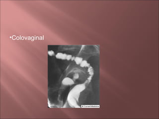 •Colovaginal
 