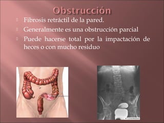    Fibrosis retráctil de la pared.
   Generalmente es una obstrucción parcial
   Puede hacerse total por la impactación de
    heces o con mucho residuo
 