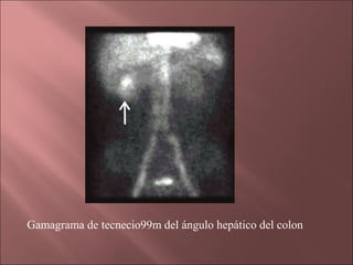 Gamagrama de tecnecio99m del ángulo hepático del colon
 