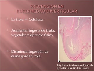    La fibra = Celulosa.

   Aumentar ingesta de fruta,
    vegetales y ejercicio físico.



   Disminuir ingestión de
    carne gorda y roja.

                                    http://www.ispub.com/xml/journals
                                    /ijs/vol7n1/diverticulitis-fig2.jpg
 