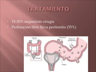    15-30% requerirán cirugía
   Perforación libre lleva peritonitis (35%)
 