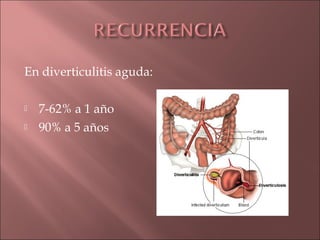 En diverticulitis aguda:

   7-62% a 1 año
   90% a 5 años
 