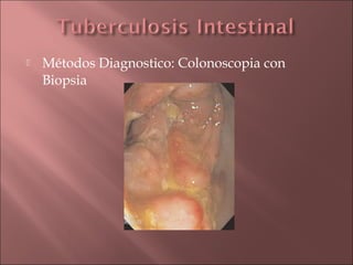    Métodos Diagnostico: Colonoscopia con
    Biopsia
 
