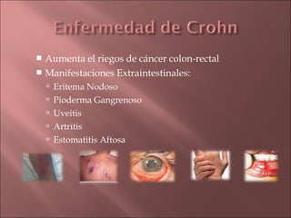  Aumenta el riegos de cáncer colon-rectal
 Manifestaciones Extraintestinales:
     Eritema Nodoso
     Pioderma Gangrenoso
     Uveitis
     Artritis
     Estomatitis Aftosa
 